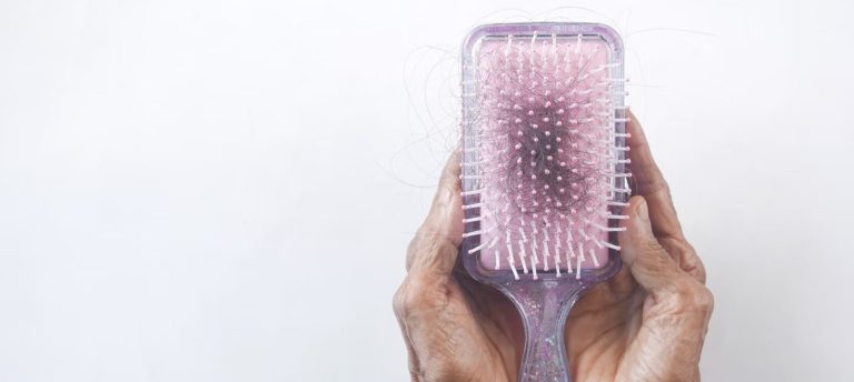 alopecia en mujeres