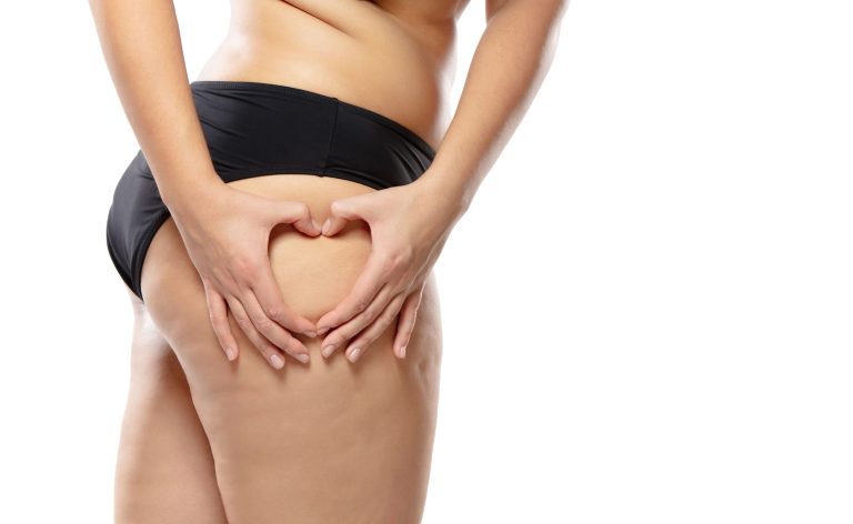tratamientos para combatir la celulitis