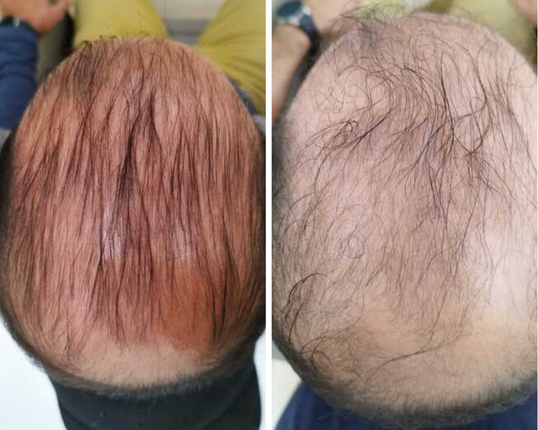 crioterapia para las patologías capilares