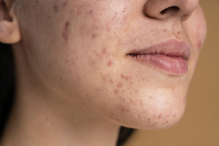 crioterapia facial para manchas