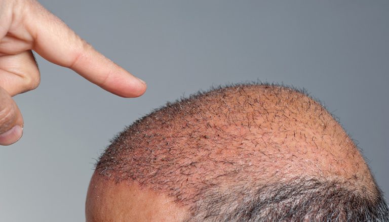 crioterapia para la prevención de la alopecia
