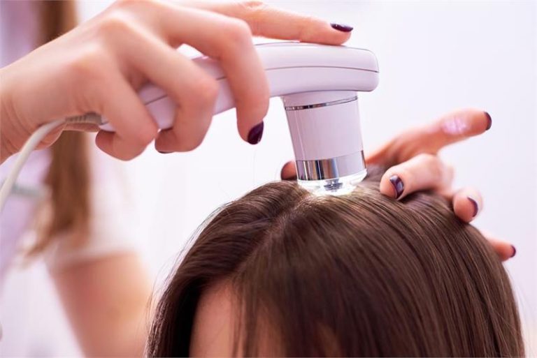 tipos de crioterapia para la alopecia