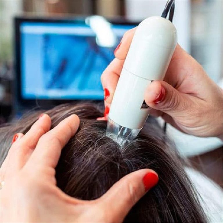 crioterapia capilar con láser