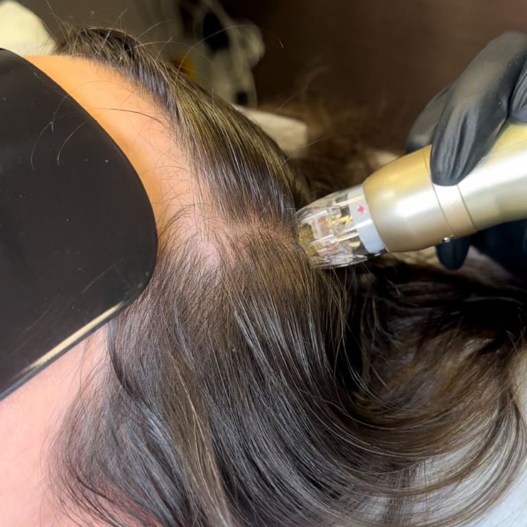crioterapia capilar y mesoterapia