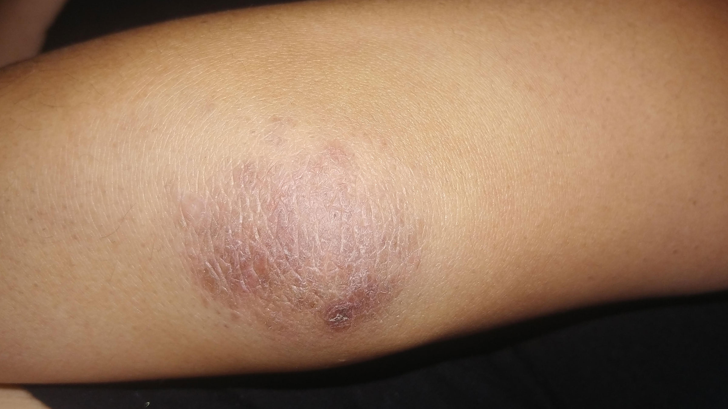 Piel seca visible en la zona del codo con textura áspera y descamación leve