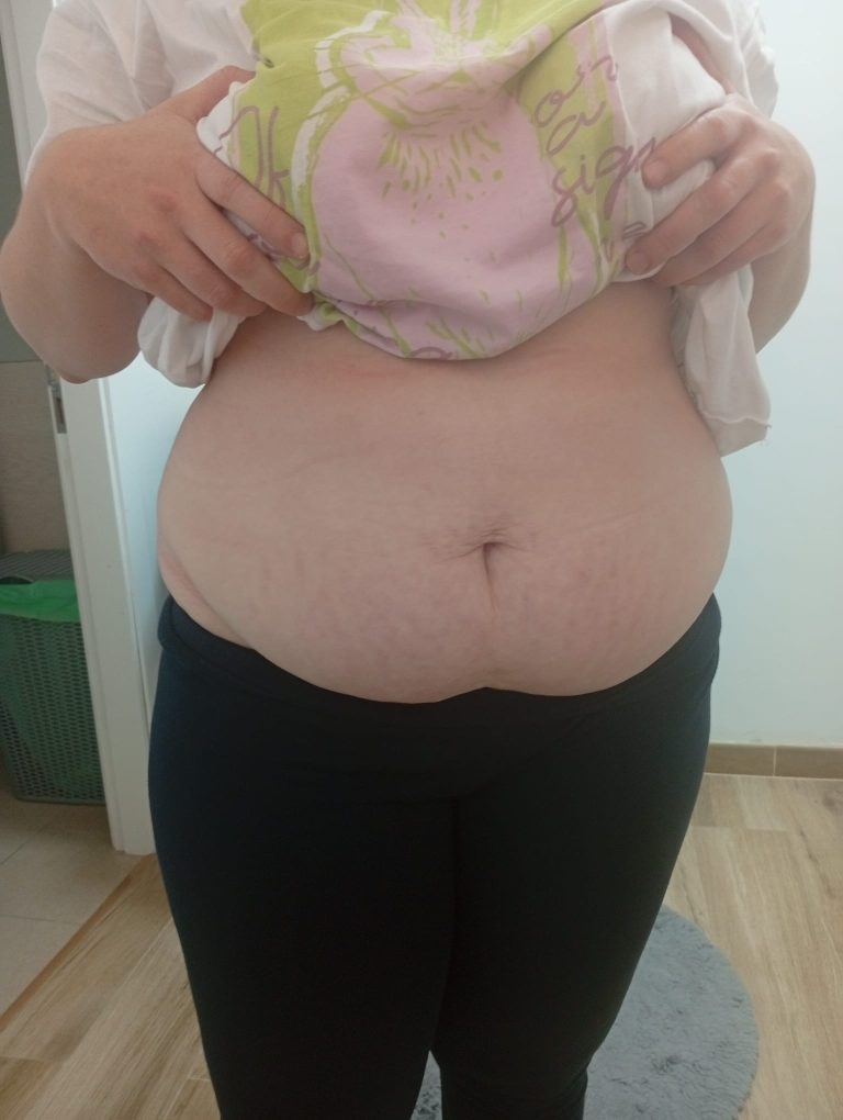 Crioterapia para mujeres con sobrepeso