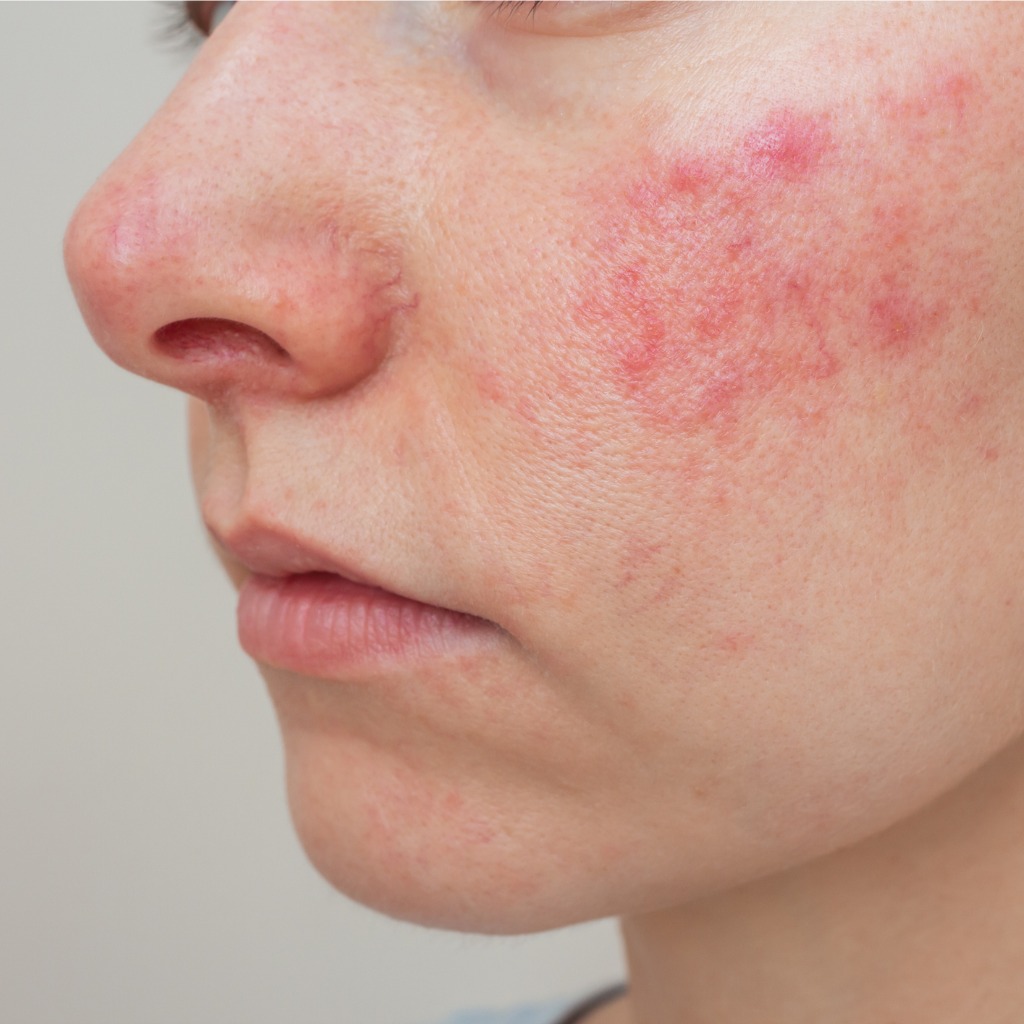 Piel facial con rojeces leves en zona de pómulos señal de sensibilidad