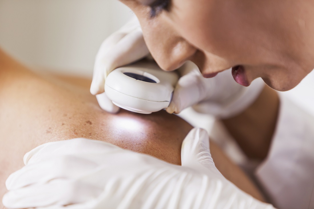 Examen dermatológico lesión superficial previo tratamiento crioterapia nitrógeno líquido