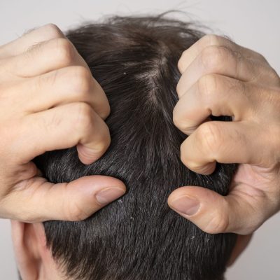 Crioterapia Capilar: Alivio del Picor en del Cuero Cabelludo