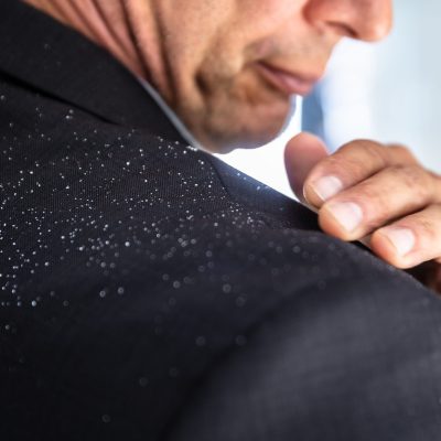 Crioterapia Capilar: Tratamiento para el exceso de Caspa