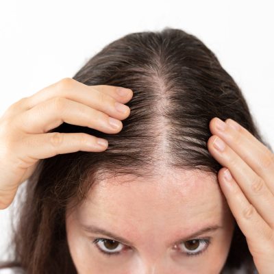 Mitos de la pérdida del cabello
