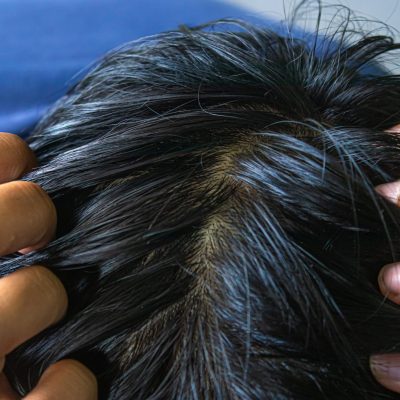 Crioterapia capilar: Tratamiento del pelo graso