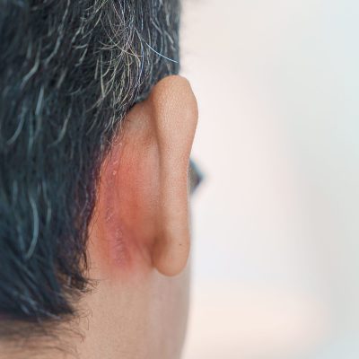 Crioterapia Capilar: Tratamiento para la Dermatitis Seborreica Crioterapia Capilar: Tratamiento para la Dermatitis Seborreica